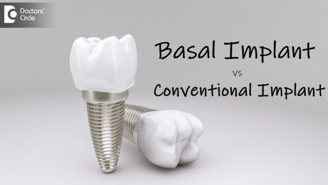 Basal Implant vs. Conventional Implant